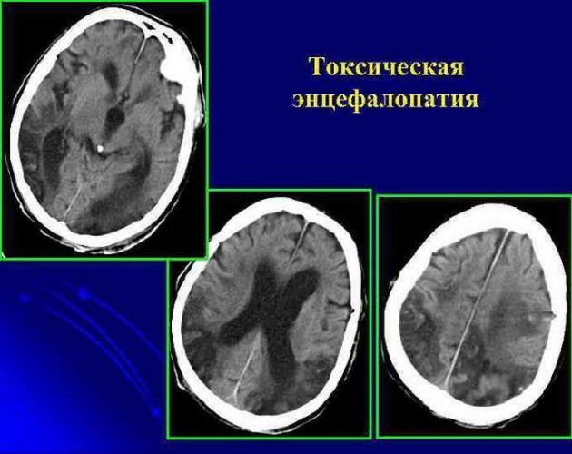 Энцефалопатия у детей: виды, особенности, симптомы, осложнения и клинический прогноз