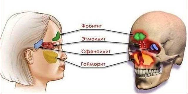 Как принимать амоксиклав при фронтите, гайморите и синусите, дозировка препарата