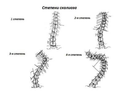 Как определить сколиоз на ранней стадии