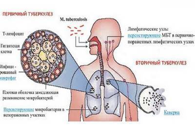Что такое туберкулез?