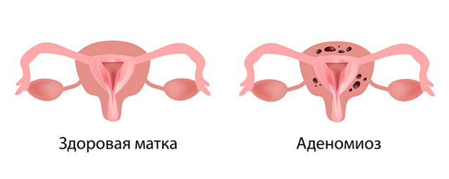 Аденомиоз матки - что это такое? симптомы, диагностика и лечение