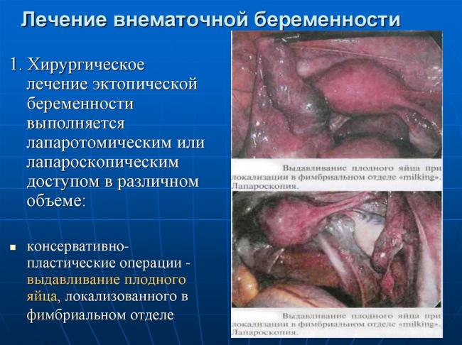 Симптомы внематочной беременности и ее последствия. симптомы и первые признаки внематочной беременности на ранних сроках
