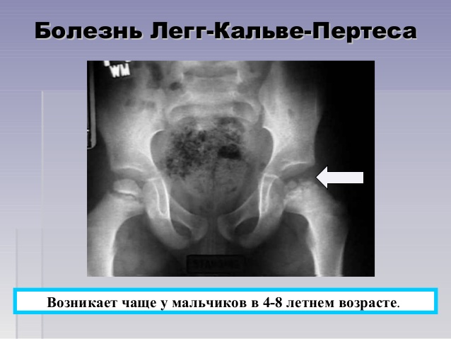 Остеохондропатия – классификация, причины, симптомы, диагностика, лечение