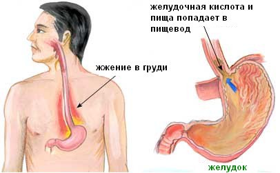 Симптомы изжоги
