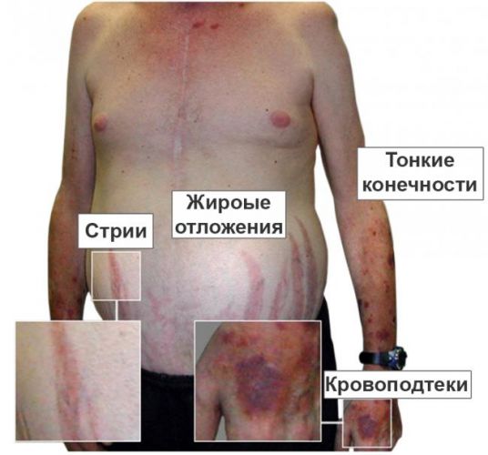 Болезнь иценко кушинга (гиперкортицизм). причины, симптомы, современная диагностика и лечение заболевания.