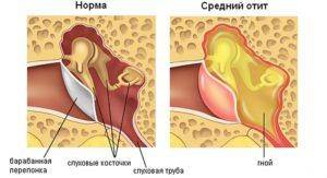 Боль в горле при глотании с одной стороны и отдает в ухо лечение