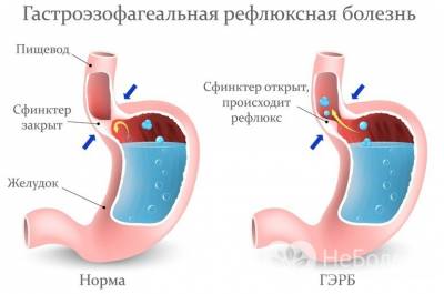 Гастроэзофагеальный рефлюкс — симптомы у детей и взрослых, лечение гастроэзофагеальной рефлюксной болезни