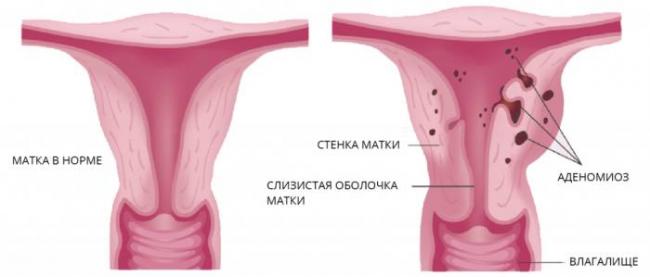 Победить аденомиоз матки