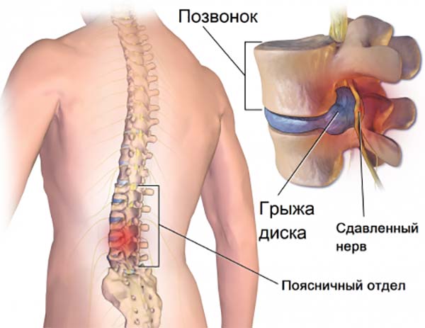 Сколько дней температура при остеохондрозе?
