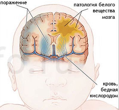 Ишемия головного мозга у новорожденного: что это, последствия и лечение, степени и особенности поражения у недоношенных детей