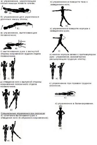 Какую пользу приносят упражнения при сколиозе 1 степени
