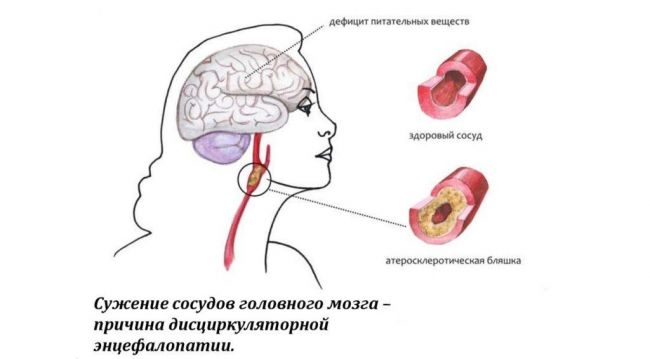 Энцефалопатия - виды, симптомы, лечение