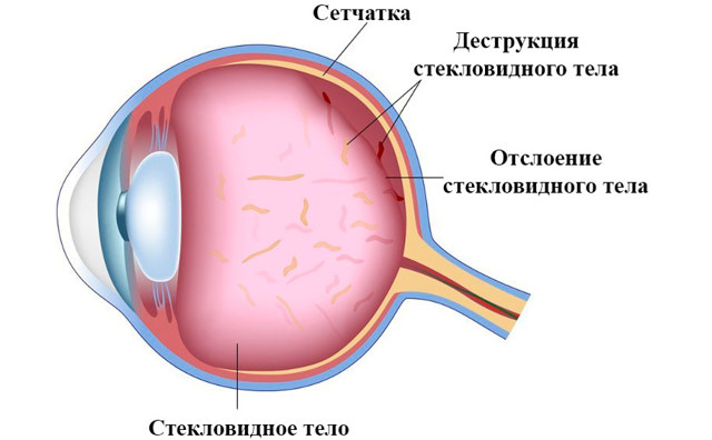 Заболевания стекловидного тела. диагностика и лечение
