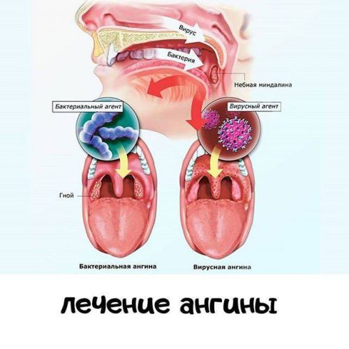 Гнойная ангина у ребенка 4 года лечение в домашних условиях