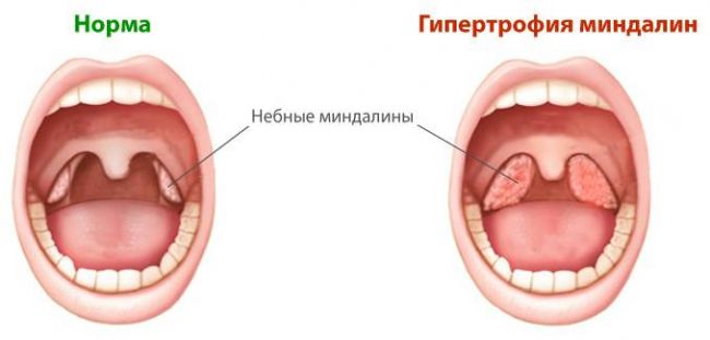 Острый тонзиллит: лечение у детей и взрослых, симптомы, код по мкб 10