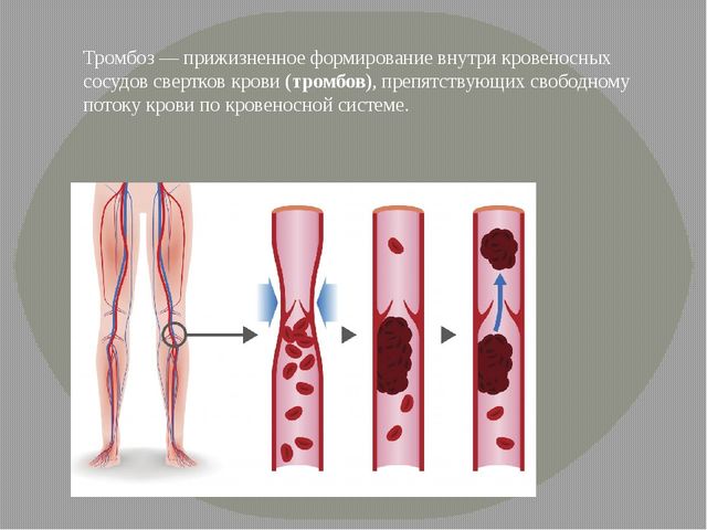 Тромбоз вен: симптомы, диагностика, профилактика и лечение