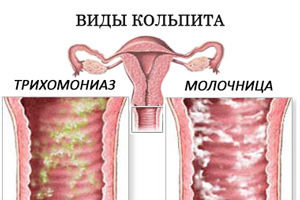 Кольпит. симптомы и лечение у женщин трихомонадный, кандидозный, сенильный, атрофический, неспецифический, хронический, грибковый. свечи, препараты