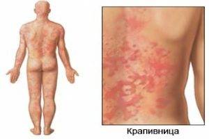 Аллергия на дрожжи у детей и взрослых, симптомы, лечение