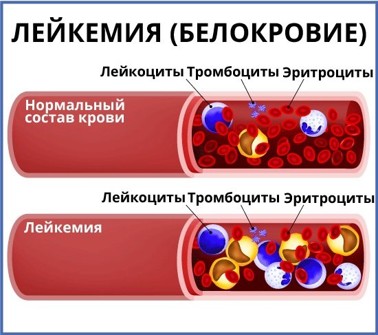 Лейкемия признаки по общему анализу крови