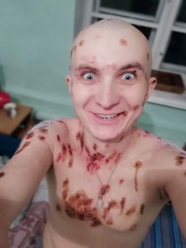 Себорея у ребенка на волосистой части головы и лице
