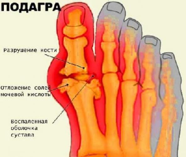 Эффективность диеты при подагрическом артрите. как питаться?