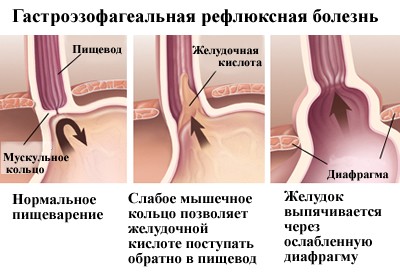 Гастроэзофагеальная рефлюксная болезнь