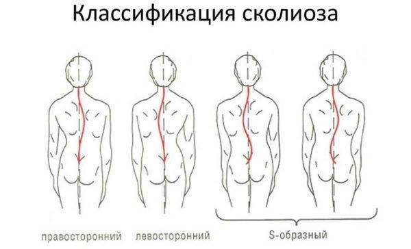 Лечебная гимнастика при сколиозе в домашних условиях: лечение грудного отдела позвоночника, видео