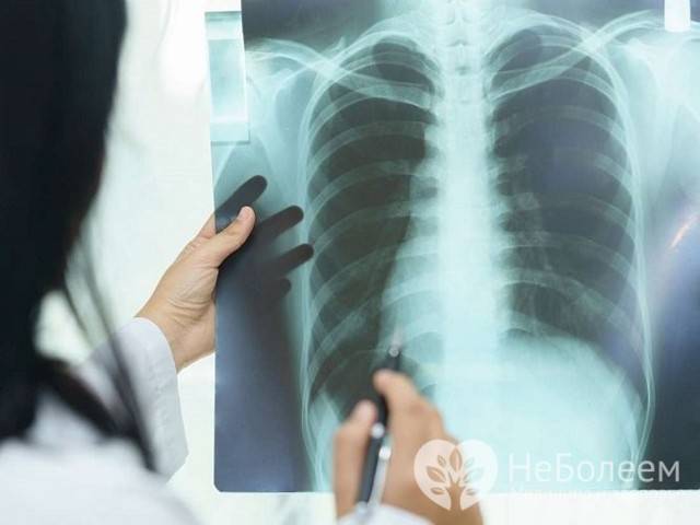 Пневмония у лежачих больных: диагностика, лечение, профилактика