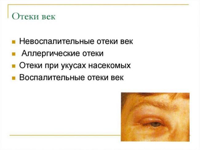 Как снять отек с верхнего века: быстро убрать дефект, что нужно срочно делать, если отекли веки