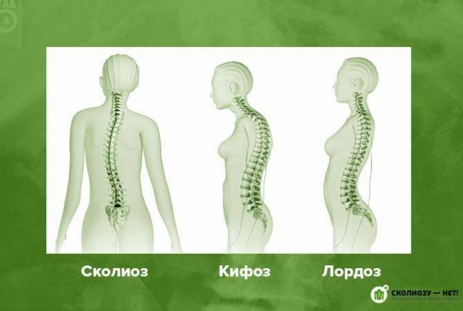 Левосторонний сколиоз