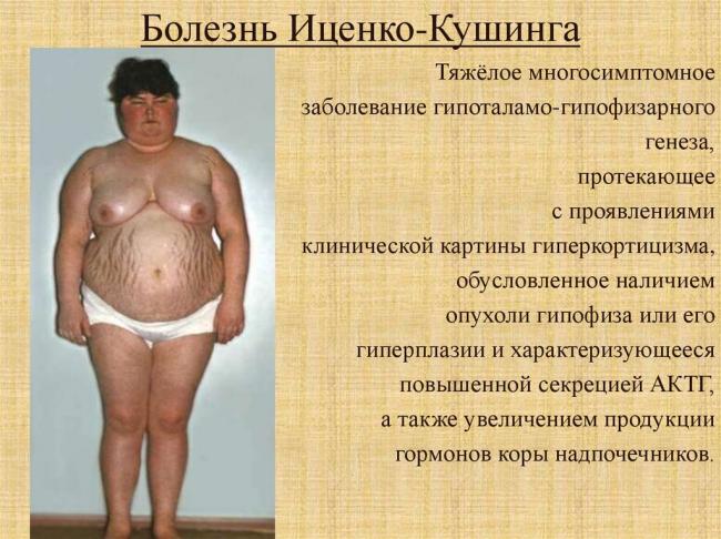Вторичный гиперкортицизм или болезнь иценко-кушинга!