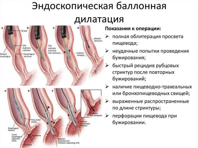 Дисфункция сфинктера одди и синдром избыточного бактериального роста в кишечнике