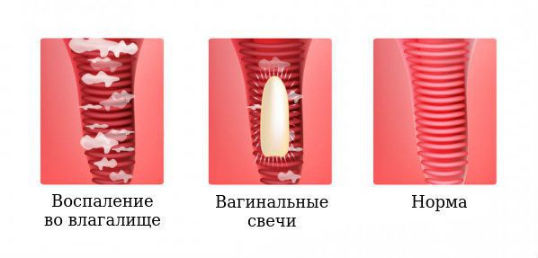 Хронический вагинит: признаки, лечение, профилактика