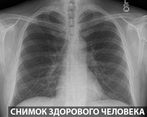 Рентгеновское исследование при пневмонии. симптомы, признаки, описание рентгена при пневмонии