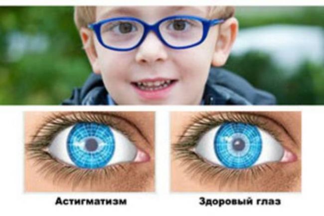 Причины и лечение миопического астигматизма