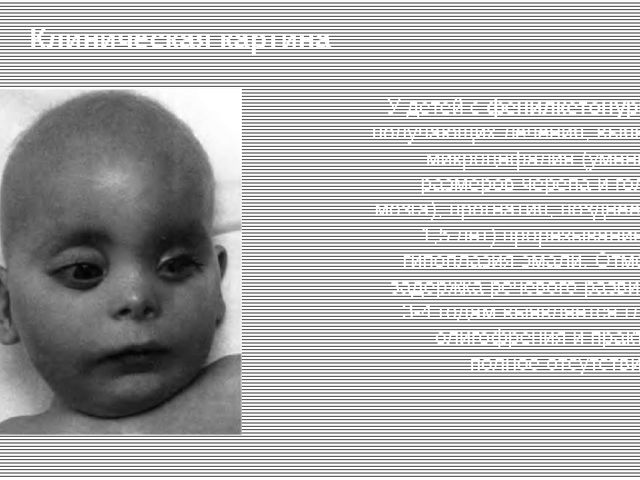 Фенилкетонурия – что это за заболевание, тип наследования? фенилкетонурия – симптомы, лечение
