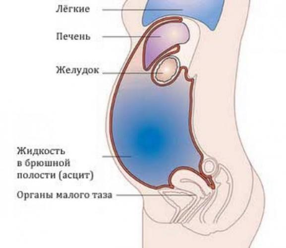 Асцит. причины, симптомы, признаки, диагностика и лечение патологии