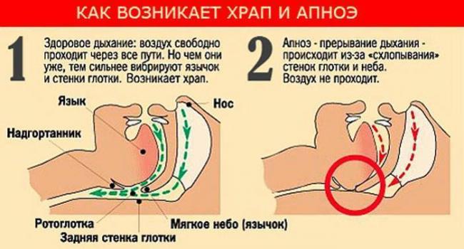 Эффективность лечения женского храпа домашними средствами