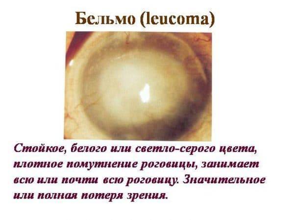 Бельмо на глазу у человека