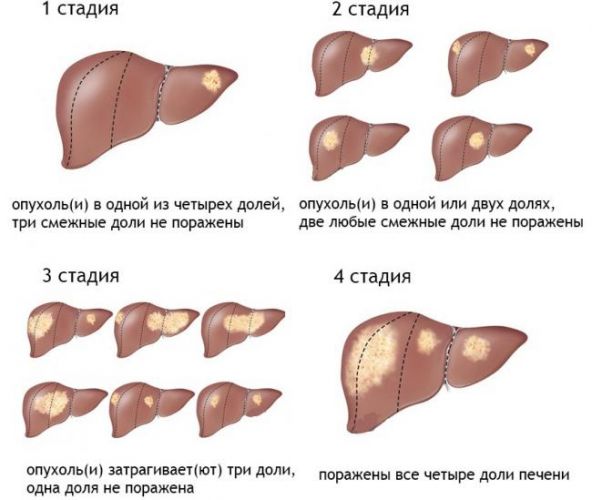 Поддается ли лечению фиброз печени 3 степени и сколько живут с таким диагнозом?