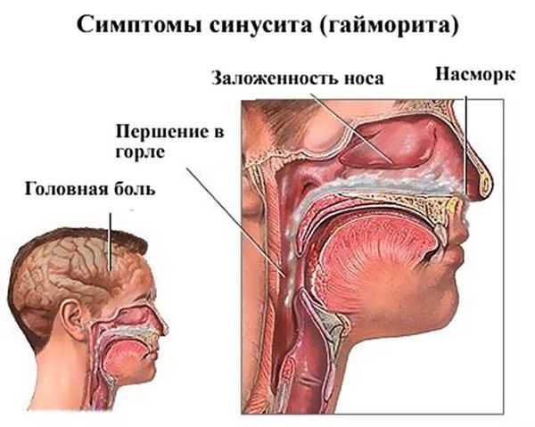 Капли в нос с антибиотиками