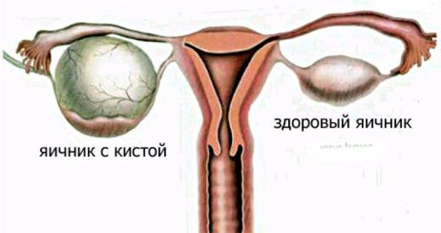 Причины появления и лечение кисты правого яичника