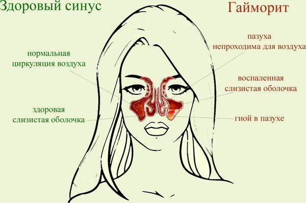 Применение Диоксидина в ухо