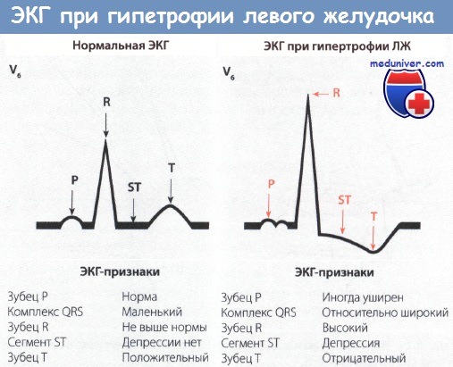 Гипертрофия правого желудочка на экг - признаки