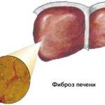 Гепатит B: симптомы и лечение, сколько живут с вирусом?