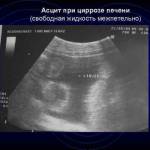 Что такое асцит печени: симптомы и лечение